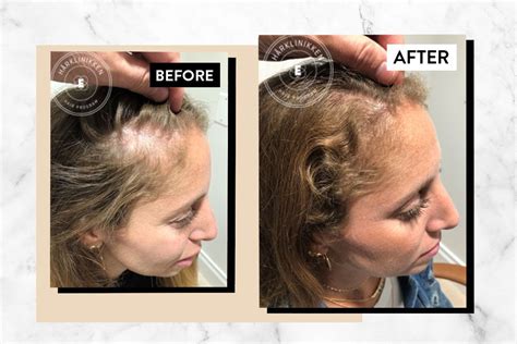 tony robbins hair|I Tried Harklinikken, the Buzzy Scandinavian Hair.